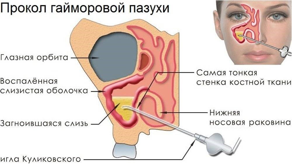 Гайморит - причины, симптомы, диагностика, лечение и профилактика. гайморит у детей и при беременности. вопросы и ответы