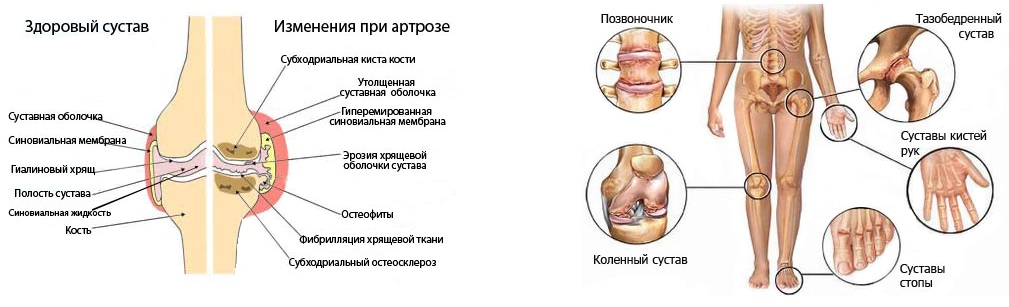 Дегенеративно-дистрофические заболевания суставов: рассмотрим подробно патологию