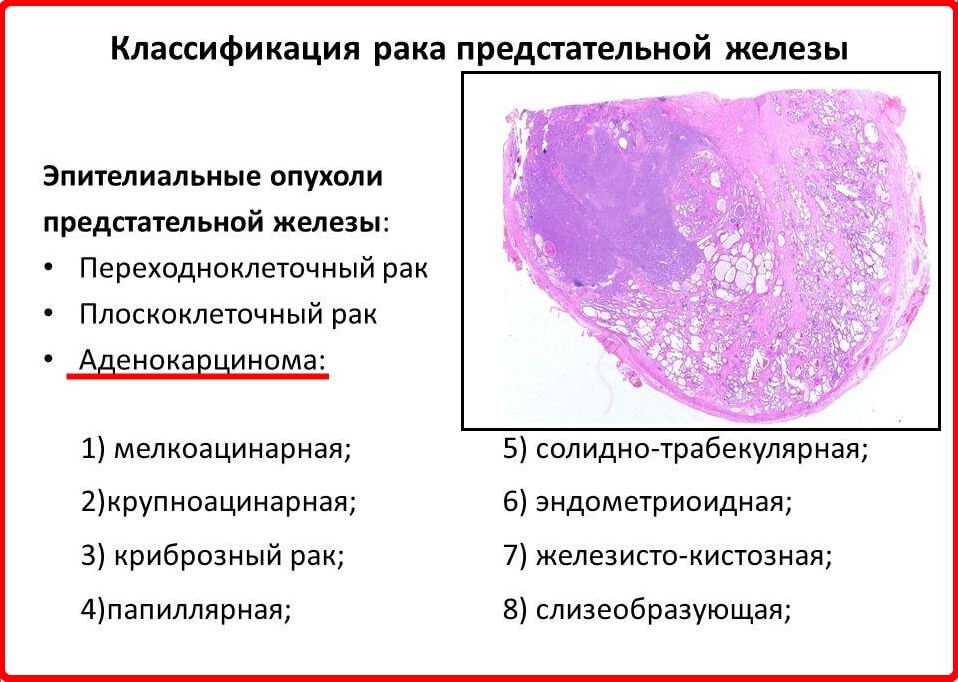 Первые признаки рака простаты