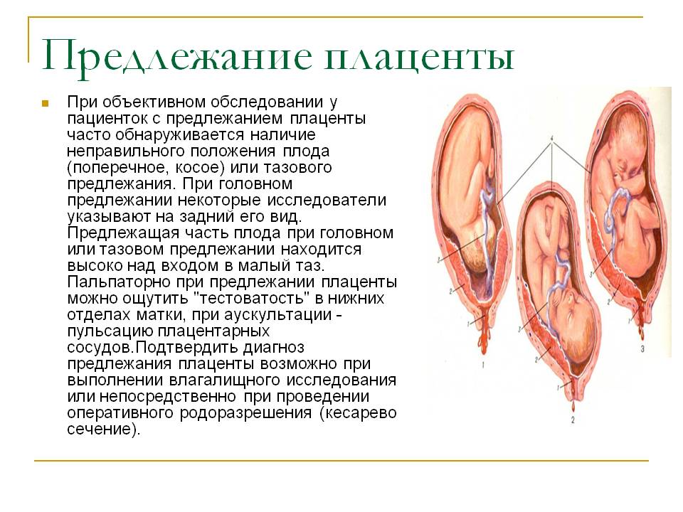 Низкая плацентация – не диагноз, но предупреждение