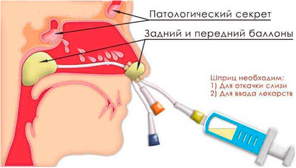 Острый верхнечелюстной синусит: виды, симптомы, лечение