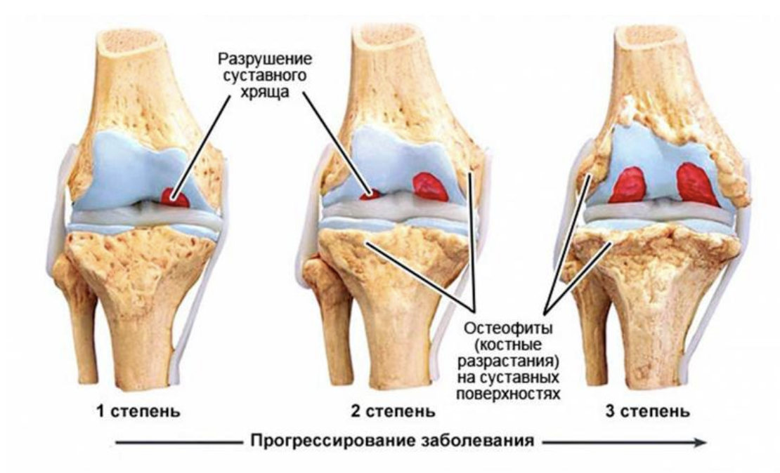Список лучших упражнений при артрозе тазобедренного сустава 2 степени