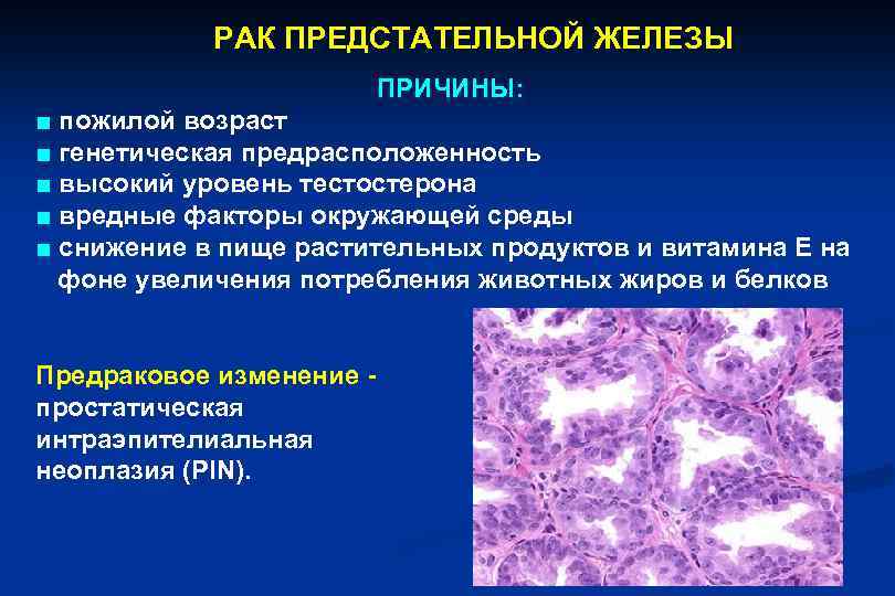Рак простаты – злокачественные новообразования в предстательной железе мужчины.