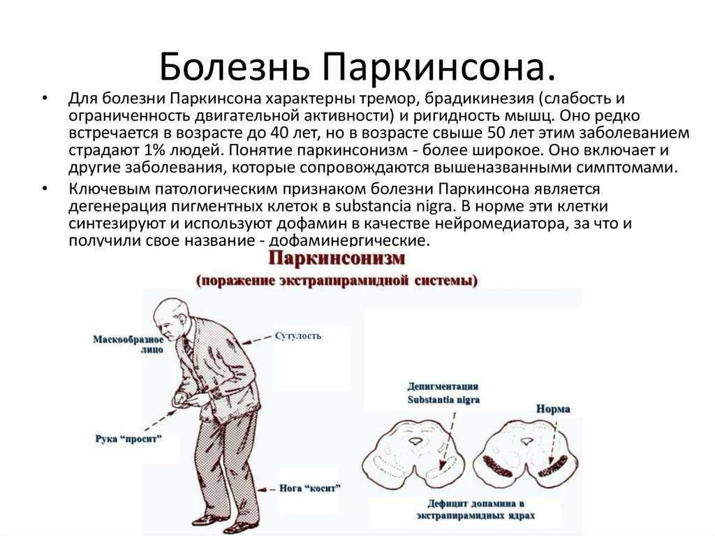 Паркинсонизм