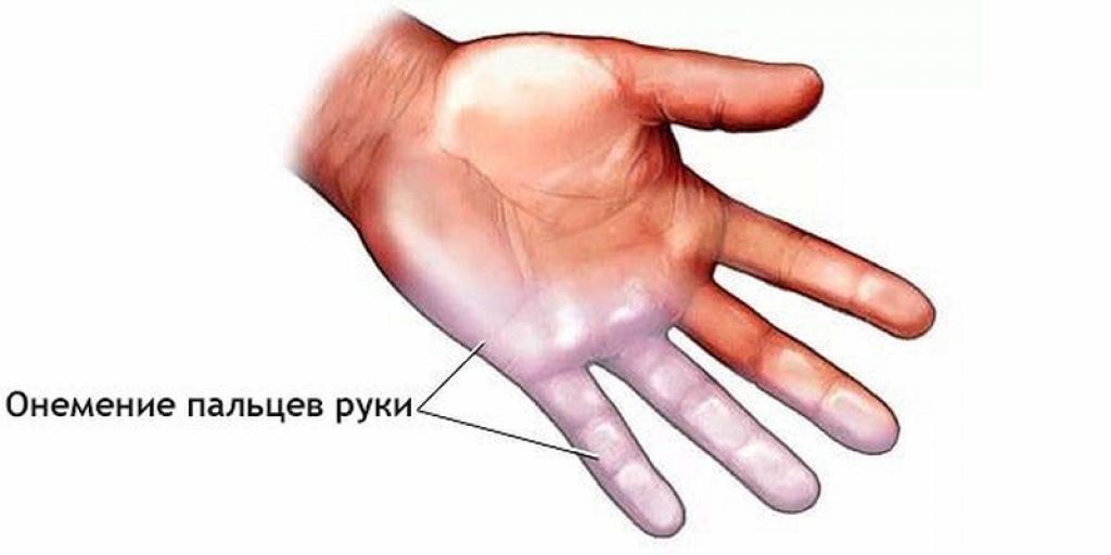 7 причин почему немеют пальцы на левой руке: что делать, лечение